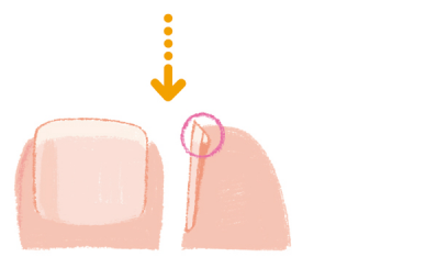 指先よりも爪のほうが１㎜程度長いのが正しい切り方。横から見たとき、爪の角が埋没していないことを確かめてください