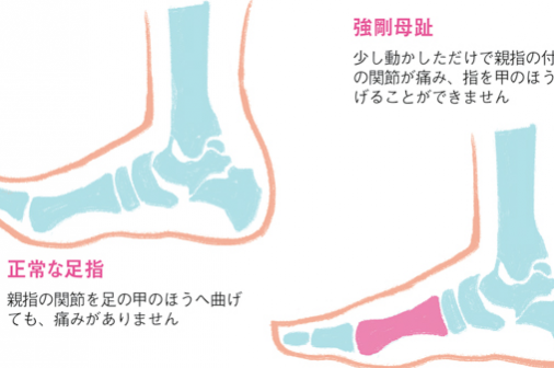 足の５大トラブルの原因と治療②親指の付け根が痛む「強剛母趾」