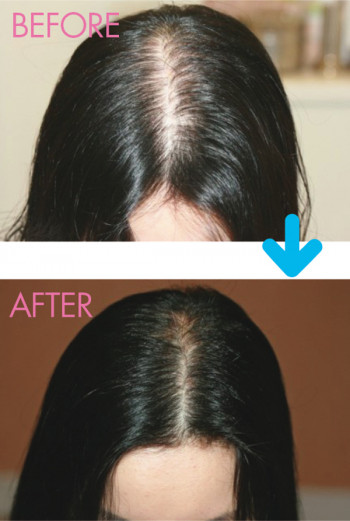 「育毛メソEX」を受けた患者さんの頭皮の変化の例。髪の本数が増え、髪自体も太くしっかりしたものに