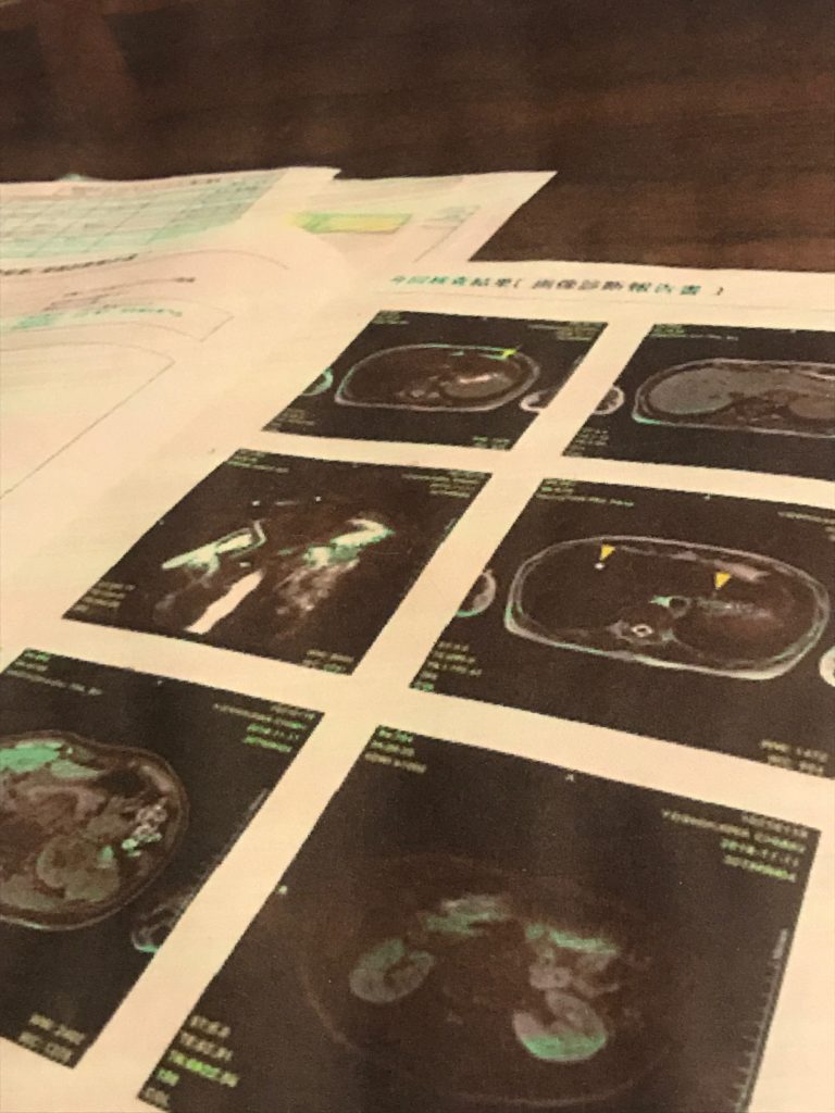 吉川千明さんが「慢性肝機能障害」の疑い診断結果を受けた時のMRIの写真