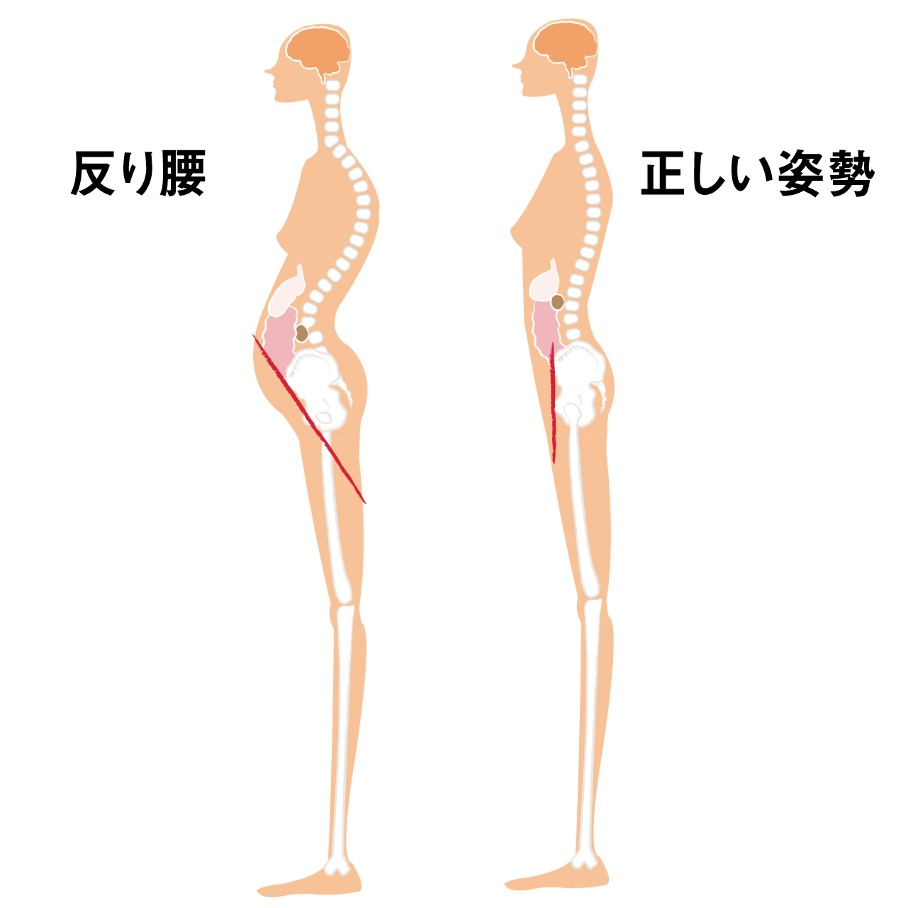 反り腰の姿勢は、骨盤が前傾した状態。これをずっと続けていると、骨盤が変形して固定されます。この体の歪みにより、脇腹とお尻の筋肉が緊張し、慢性腰痛の大きな原因に