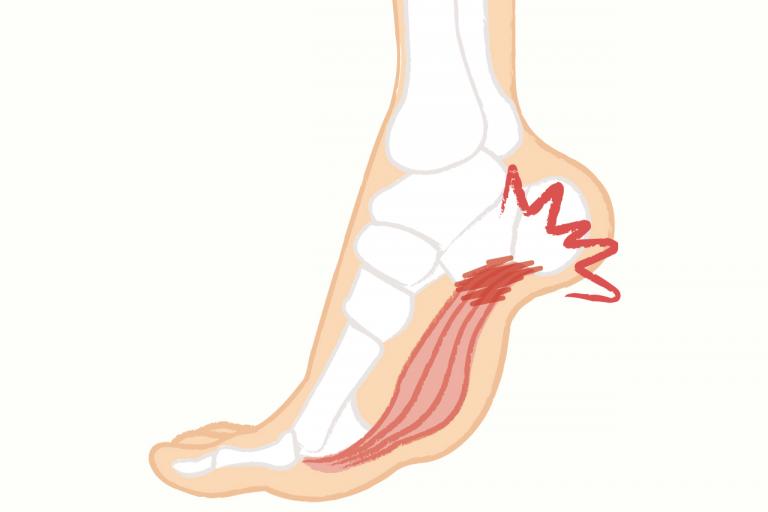足裏の痛み、かかとなら「足底腱膜（そくていけんまく）炎」、指付け根部分は「モートン病」かも？／足アーチの崩れから起こる病気③