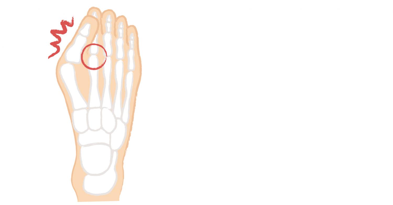 無理に動かすことで親指が脱臼。人差し指にも影響を与え、歩行困難に。