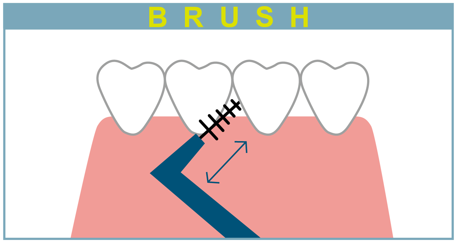 歯間ブラシで歯と歯の隙間を掃除