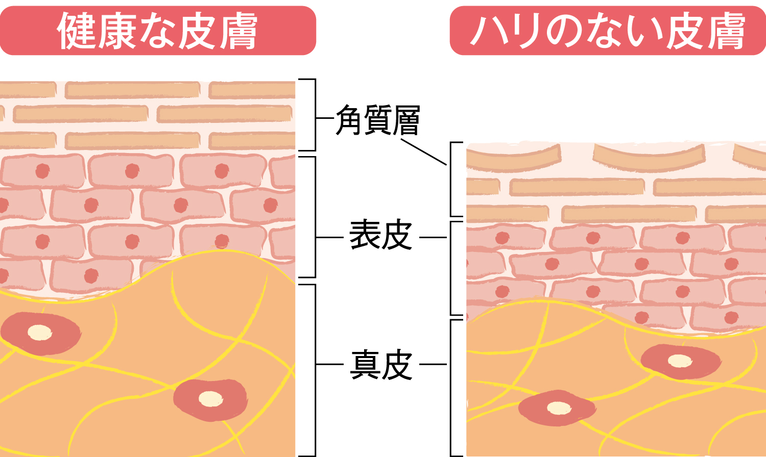 皮膚の断面図