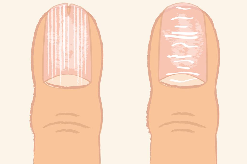 爪の縦線は老化現象、では横線には何が現れる？／手の老け見えの原因と改善法＜5＞⑧