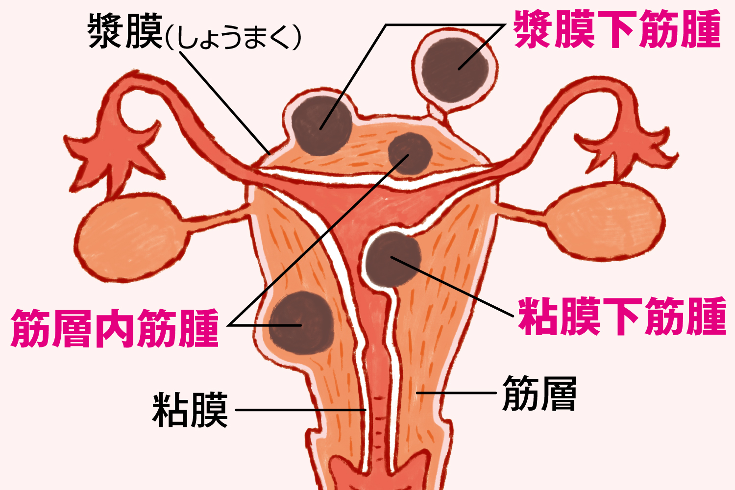 症状や進行が違う！子宮筋腫の種類とは？／子宮筋腫の新常識＜２＞⑰