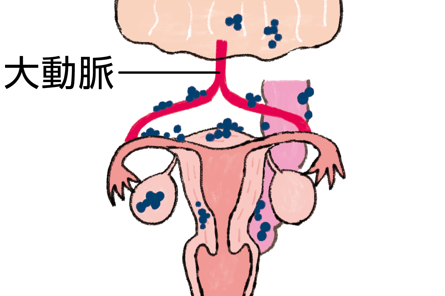 卵巣がん　Ⅲ期