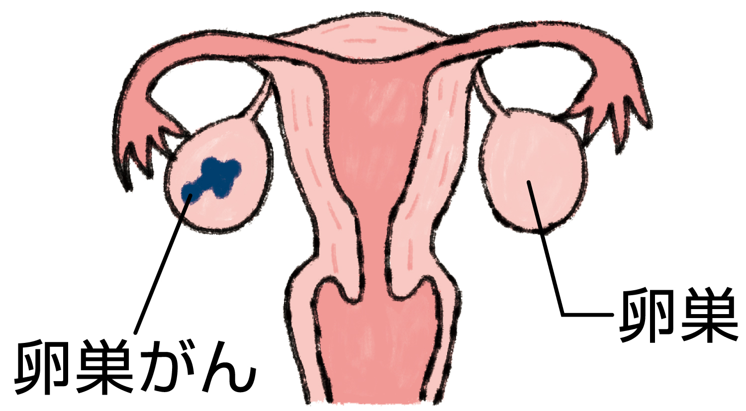 卵巣がん　Ⅰ期