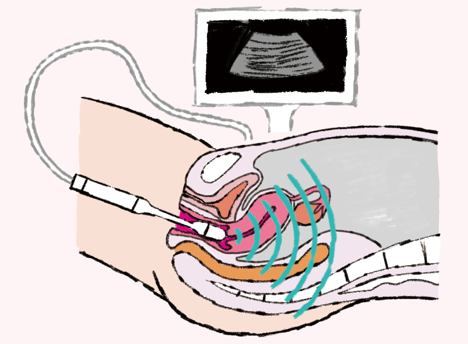 卵巣も確認できるのは経腟超音波