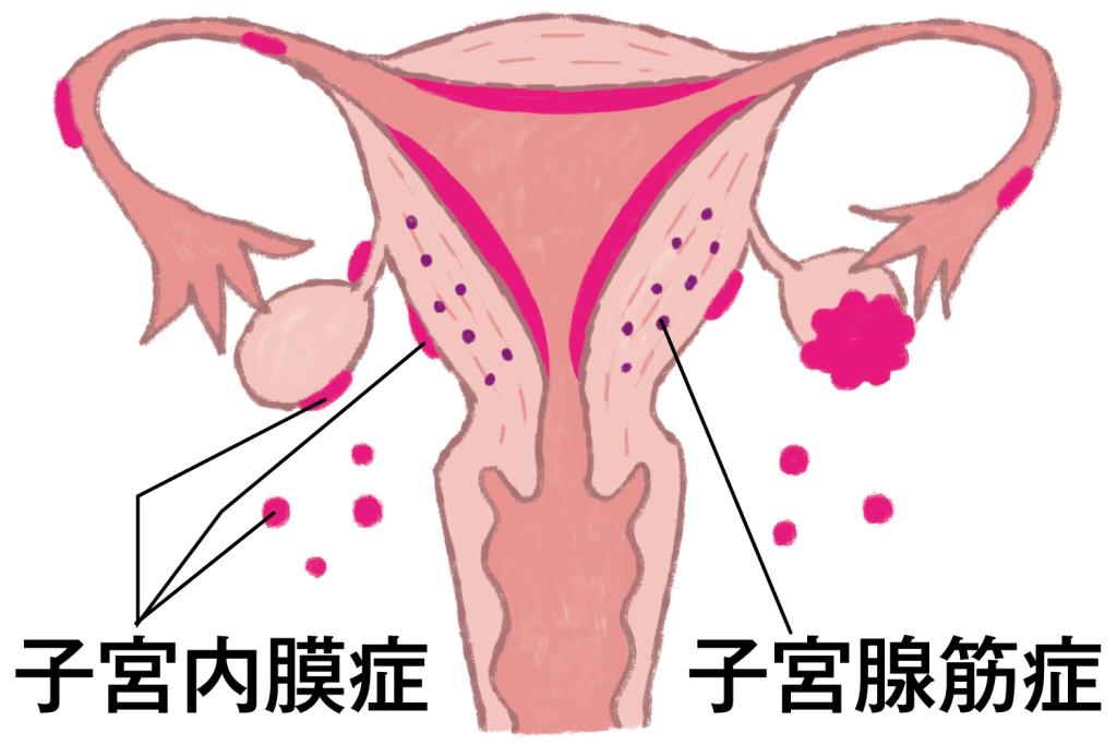 わかりにくい子宮内膜症・子宮腺筋症・子宮筋腫の違いとは？／子宮内膜症と子宮腺筋症（前）㉒