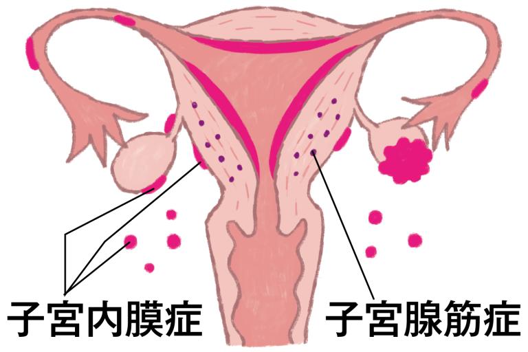 子宮内膜症・子宮腺筋症・子宮筋腫の違い、わかっていますか？／子宮内膜症と子宮腺筋症（前）