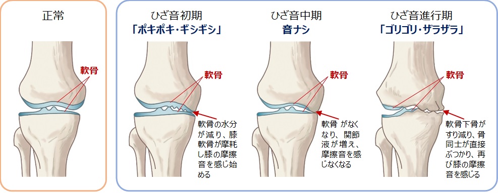健康な膝のためのヒント