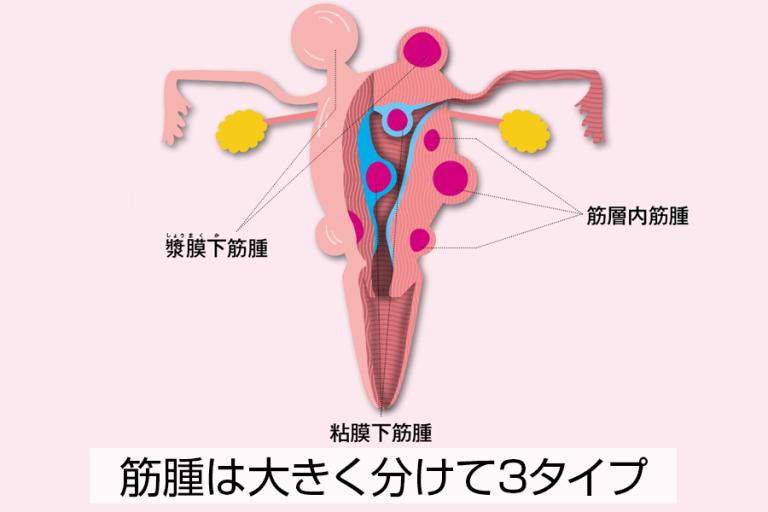 子宮筋腫は3タイプ。その違いを知っていますか？
