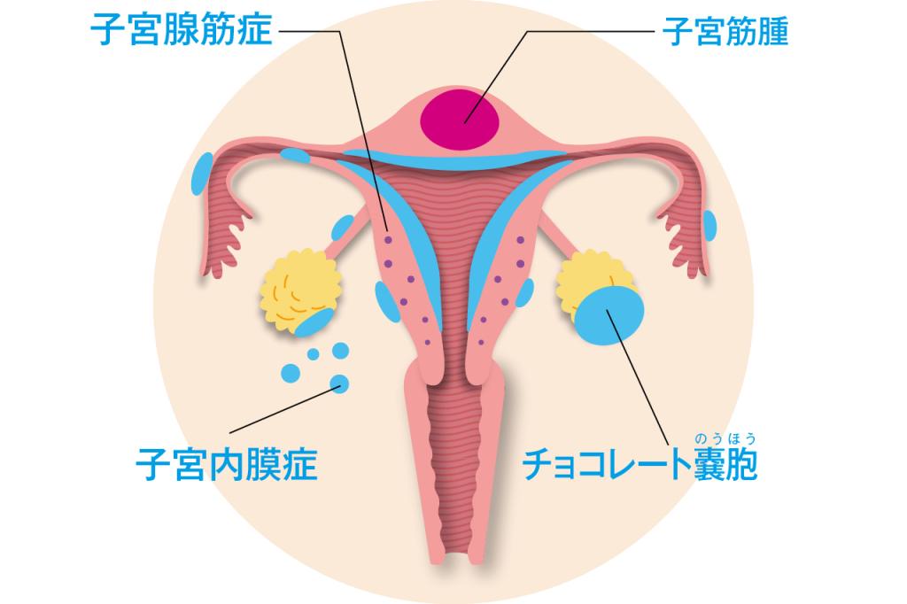 子宮筋腫、子宮腺筋症、子宮内膜症の違いをわかっていますか？
