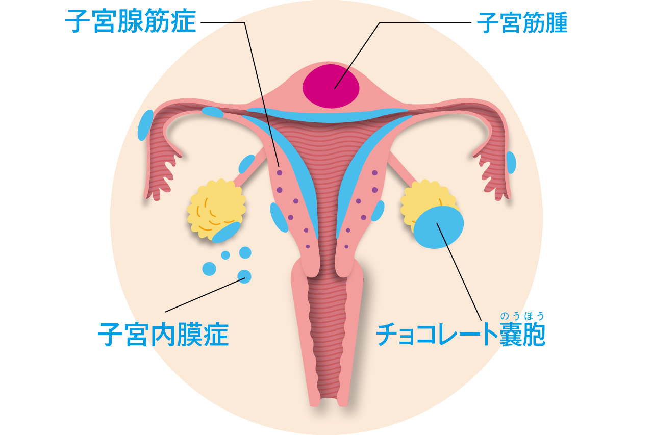 「子宮筋腫」「子宮腺筋症」「子宮内膜症」この3つの違いをわかっていますか？