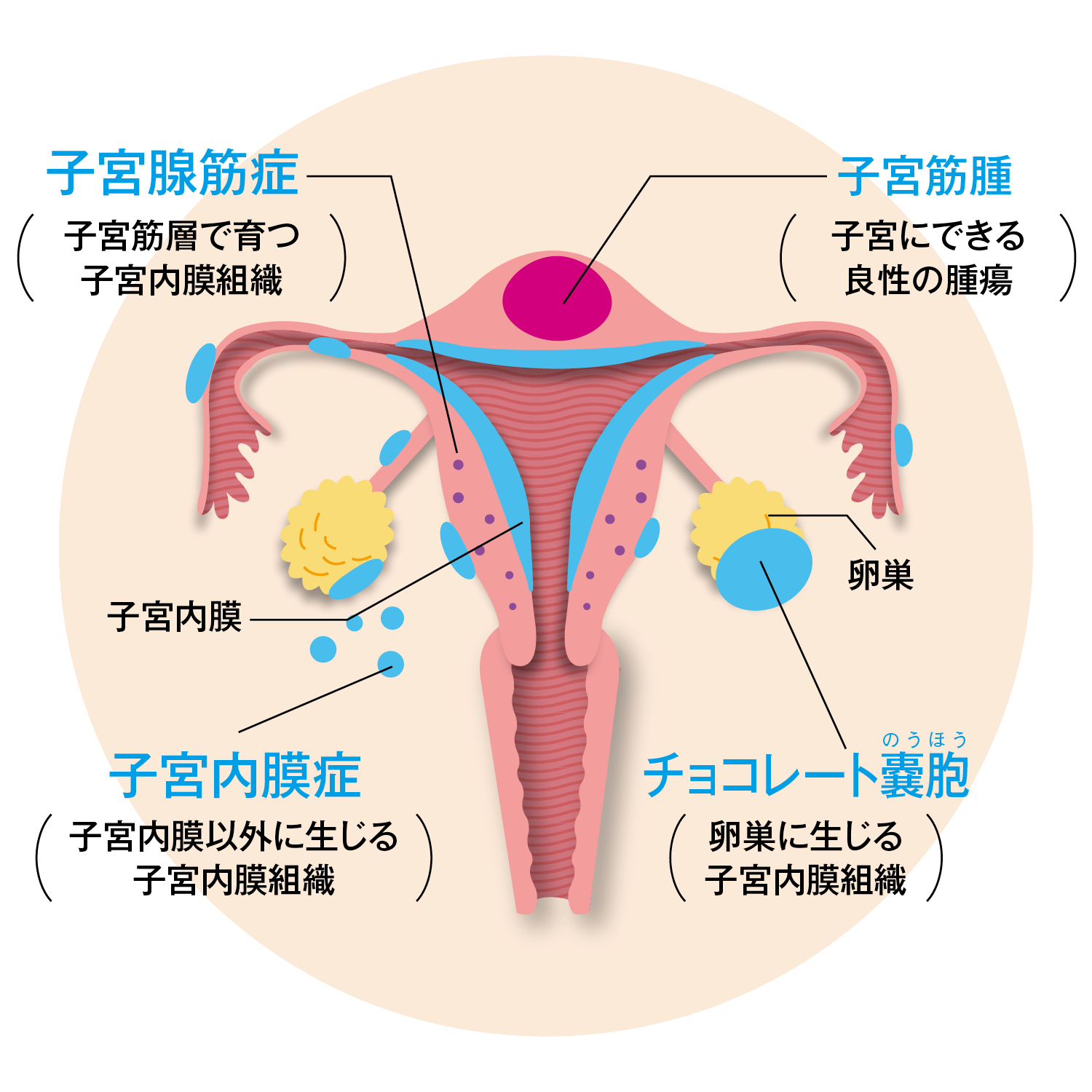 子宮筋腫・子宮腺筋症・子宮内膜症・チョコレート嚢胞