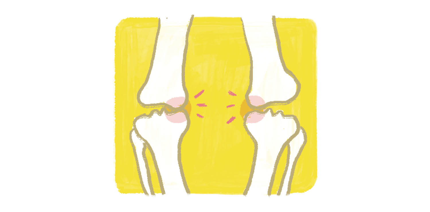 膝の内側に重点的に力がかかるため、やがて内側の軟骨がすり減って、痛みの原因に。（イラスト）
