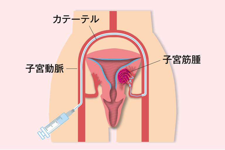 今後の妊娠を望まない人に適用される、子宮筋腫のお腹を切らない治療法3つ「UAE」「MEA」「FUS」