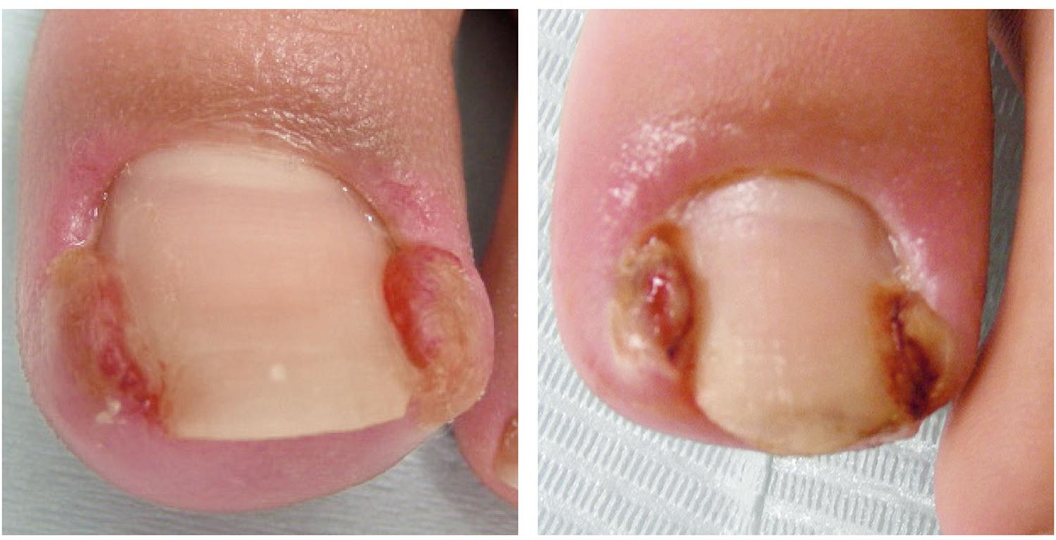 つま先ブレースの装着