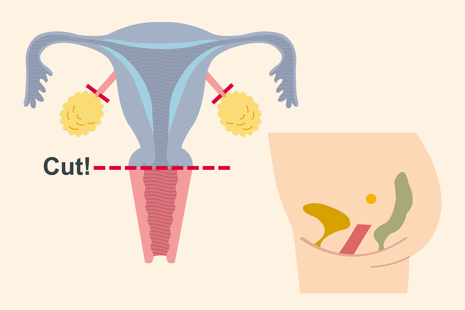 子宮筋腫の手術で子宮を取るとどうなるかイラスト解説。5人の体験談も！