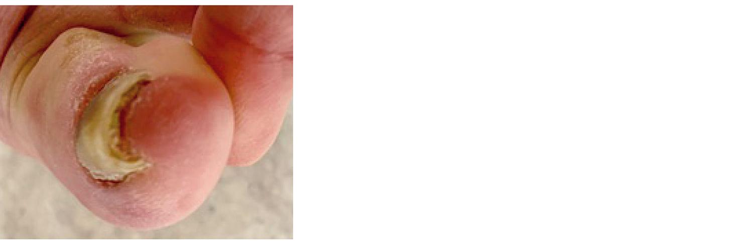 爪水虫で変形した部分が当たって痛いという症例