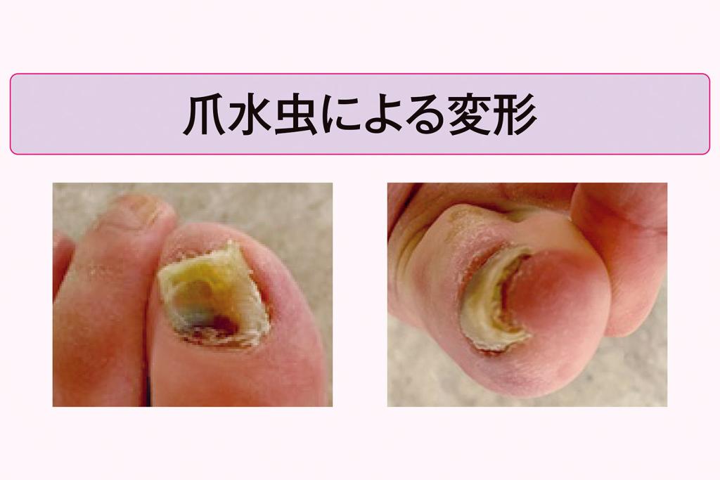 巻き爪で来院する患者さんの大半が「爪水虫」による変形です（水野寿子医師）／素敵女医の爪問題