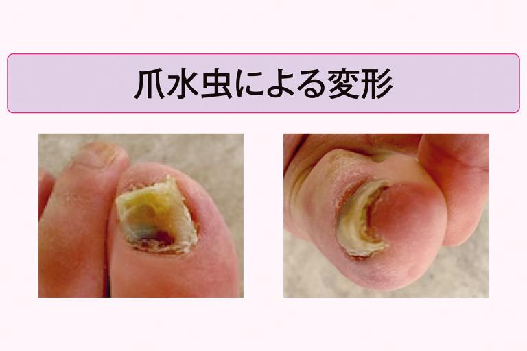 巻き爪で来院する患者の大半は実は「爪水虫」による変形。治療法は？／水野寿子医師