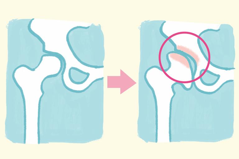 ときどき股関節に違和感がある場合、考えられる病気「変形性股関節症」をイラスト解説／下半身の痛みQ&A