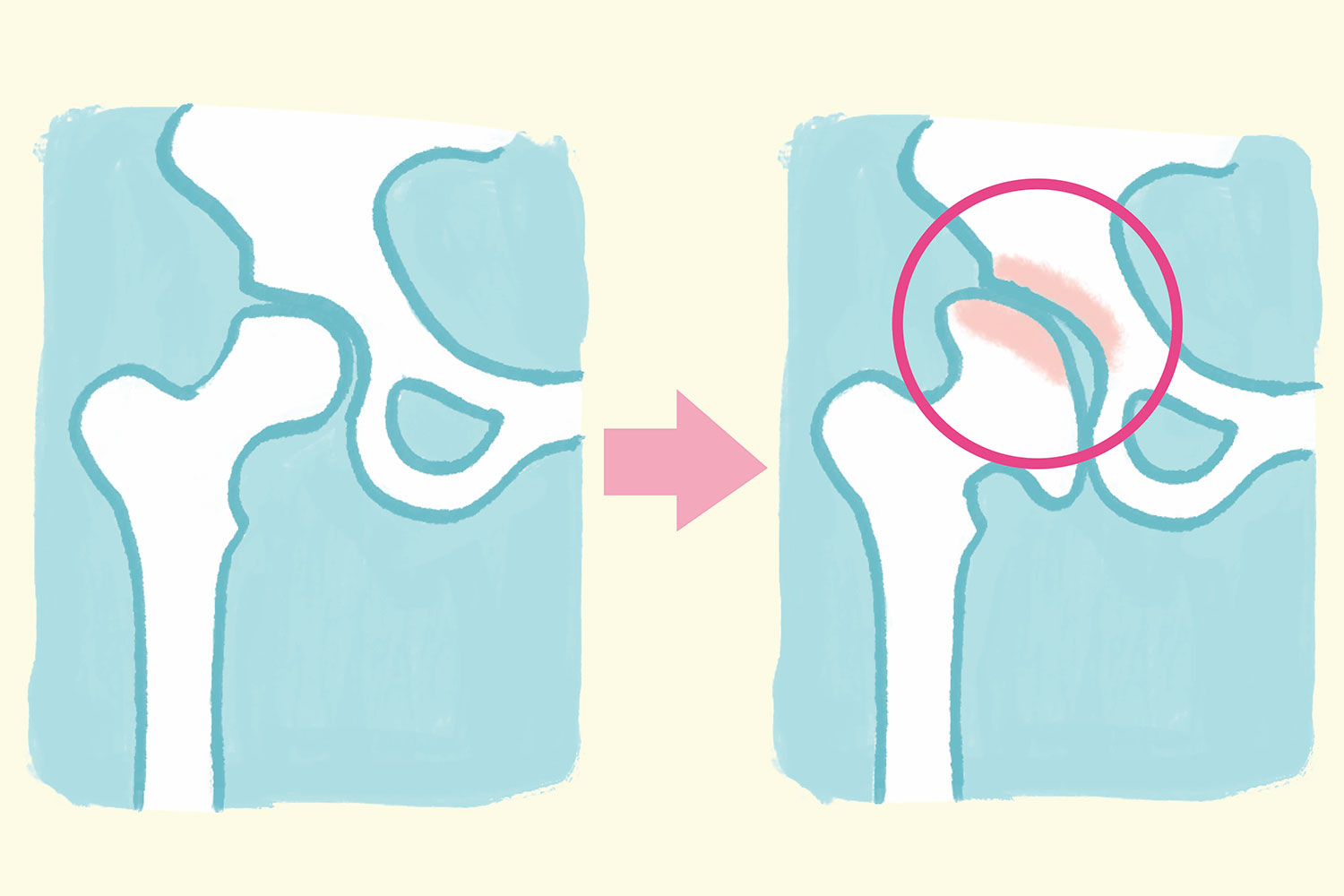 ときどき股関節に違和感がある場合、考えられる病気「変形性股関節症」をイラスト解説／下半身の痛みQ＆A