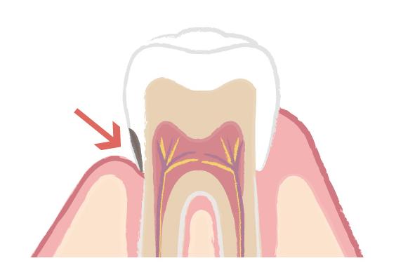 歯と歯茎の間の虫歯