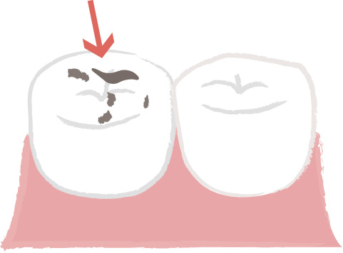 歯の上の虫歯