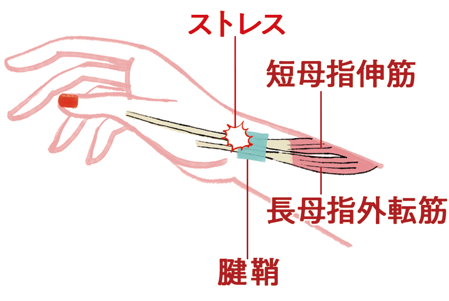腱鞘炎　解剖図