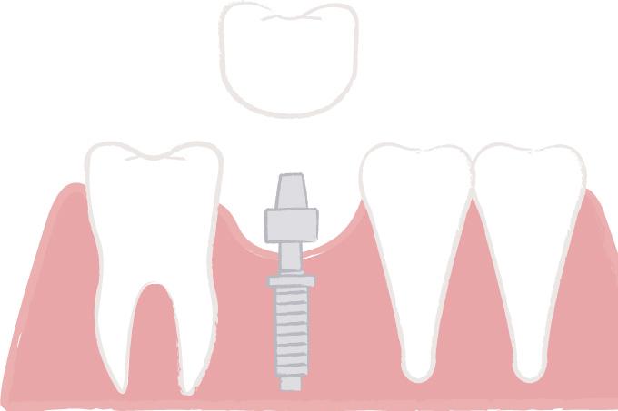 部分入れ歯、ブリッジ、インプラント。失った歯を補うベストな治療法は？