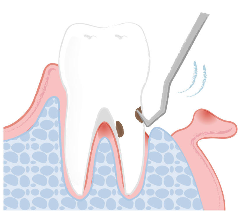 歯周病　フラップ療法