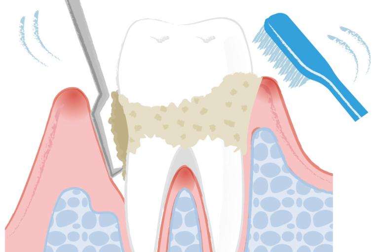 歯周病の治療は徹底した歯垢・歯石除去！ 再生医療も進化中