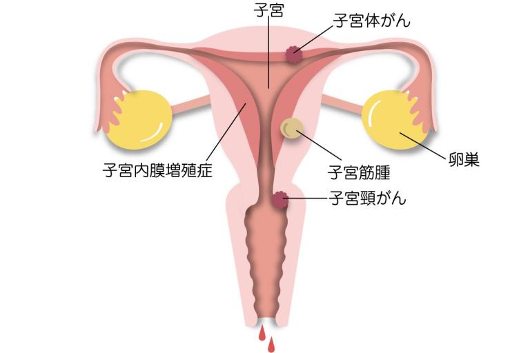 閉経前の月経不順と、子宮がんの不正出血を間違えないで！