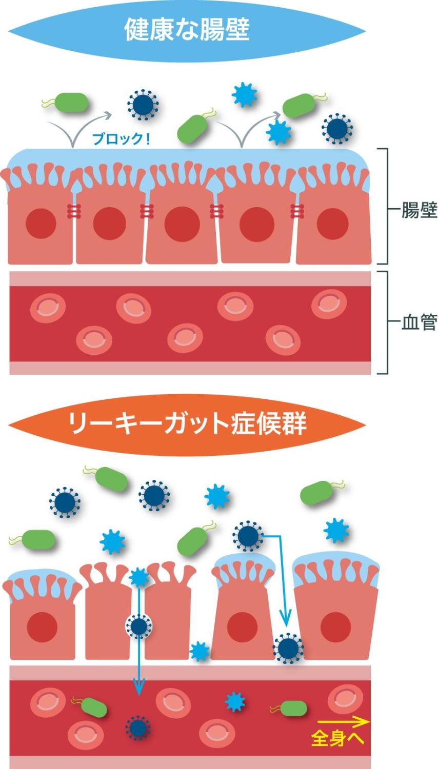 お腹のカビ　リーキーガット症候群　イラスト