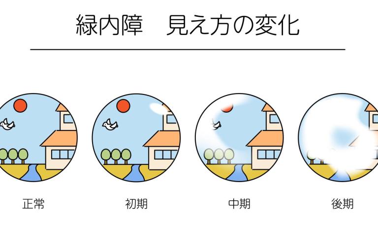 中途失明の原因、第1位は緑内障。早期発見するには？【40代、50代の目のトラブル】