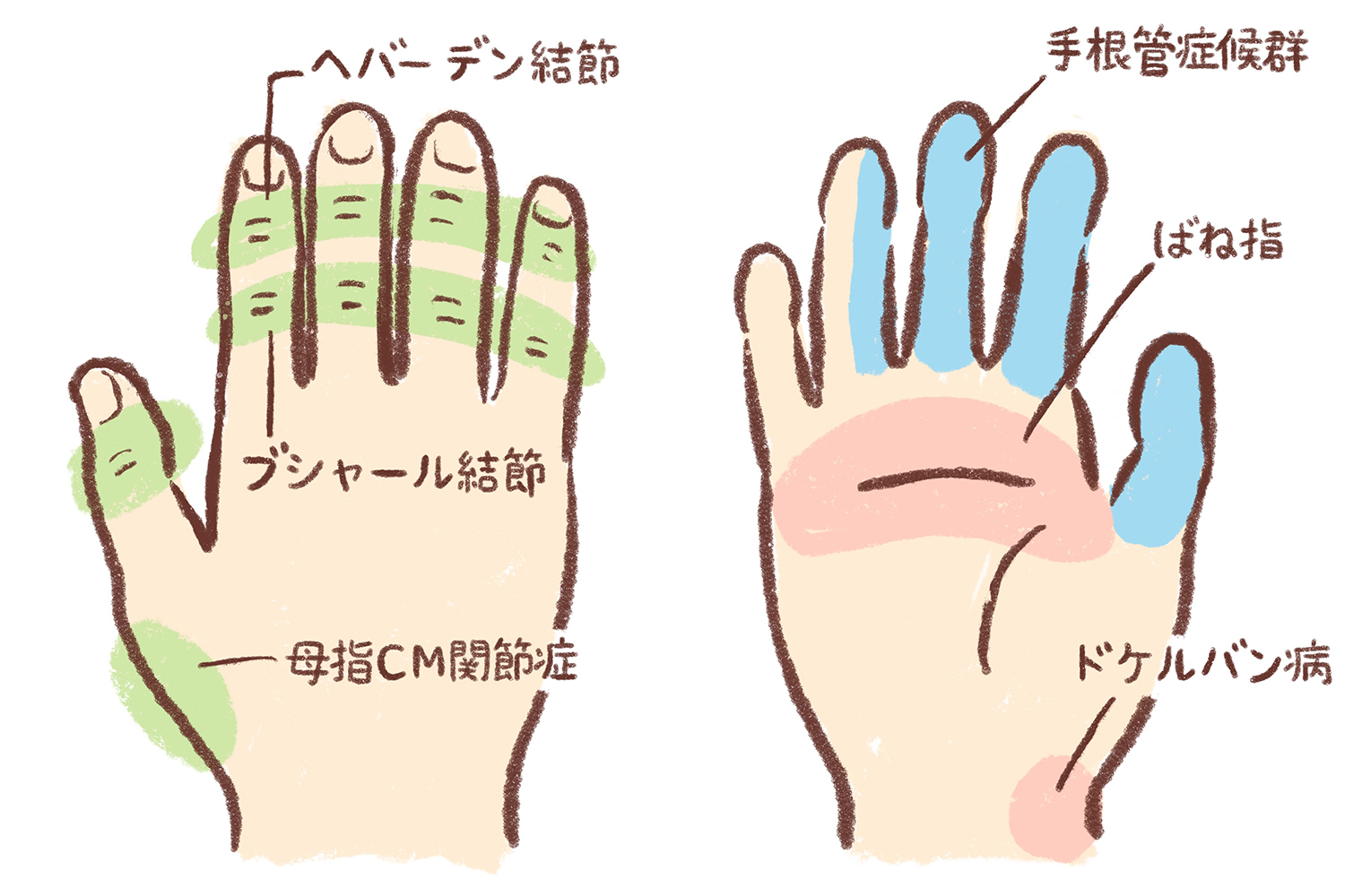 手の不調_3つの症状