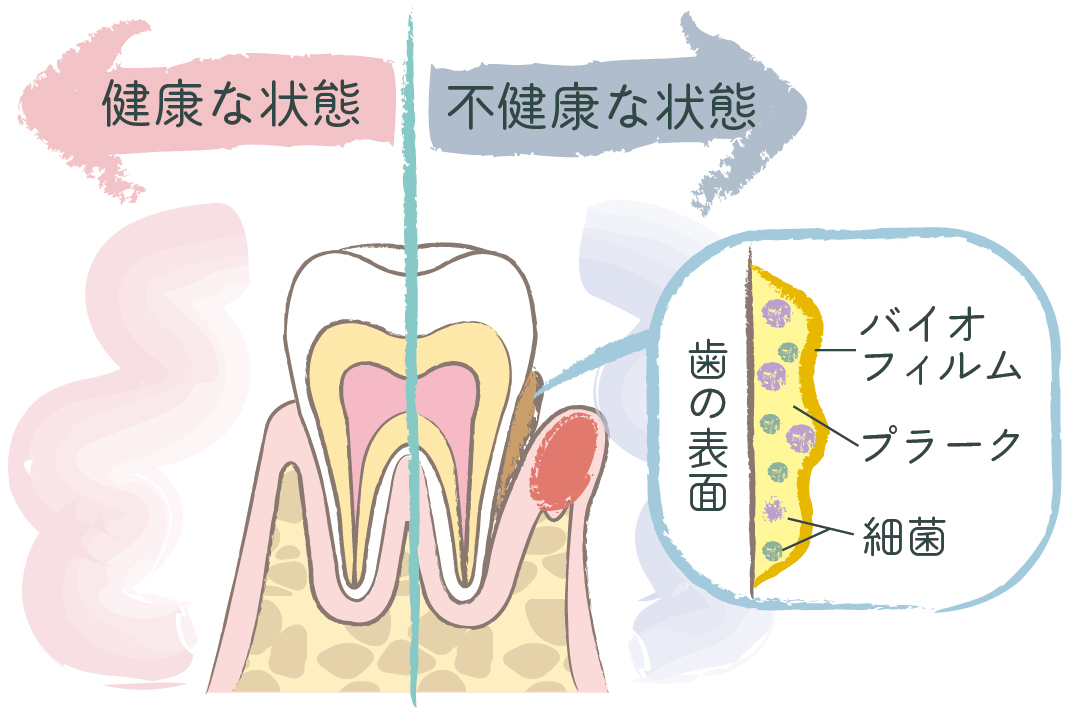 歯周病菌　バイオフィルム　歯周病