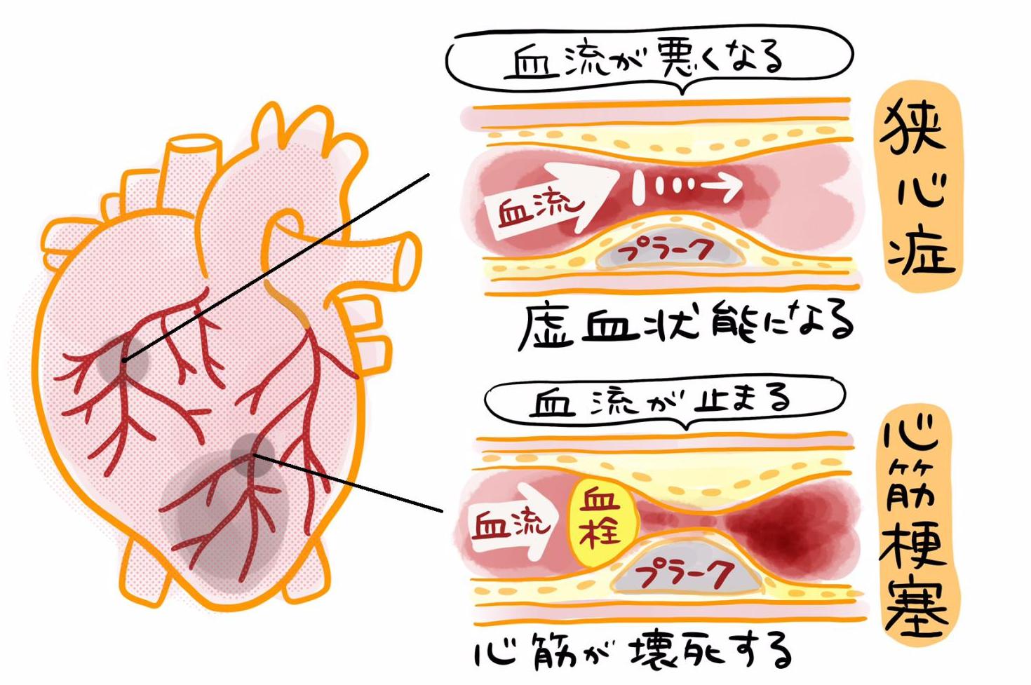 寝たきり　心臓の病気　狭心症　心筋梗塞