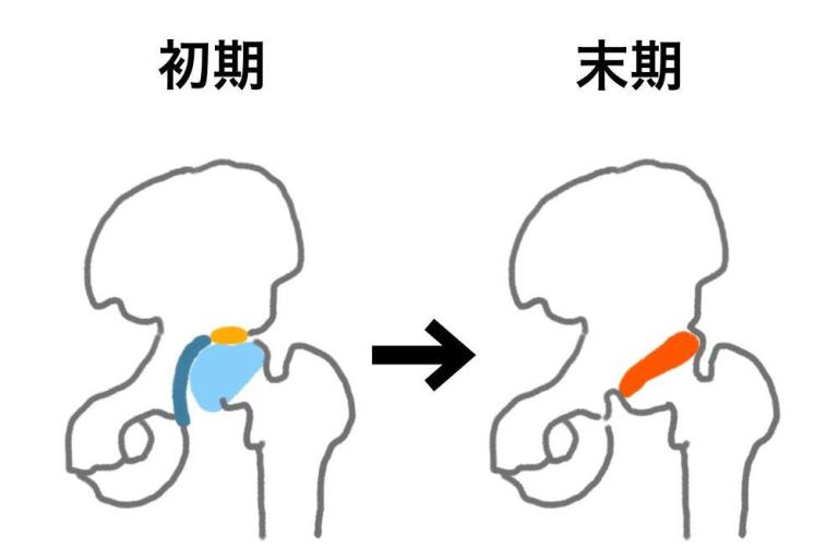 レントゲンではわからない「変形性股関節症」に要注意！