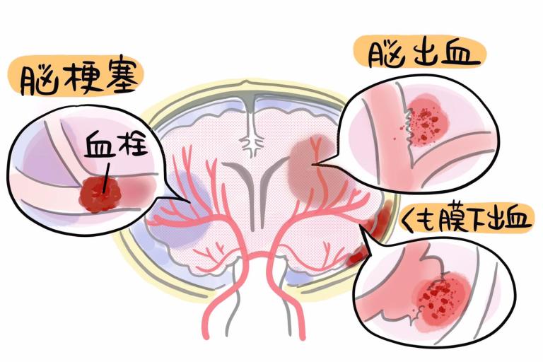 「寝たきり」になりやすい脳血管の病気は遺伝的要因が大きい!?