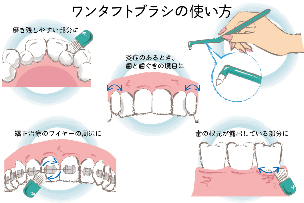 歯周病　ワンタフトブラシ　タフトブラシの使い方　　OurAge